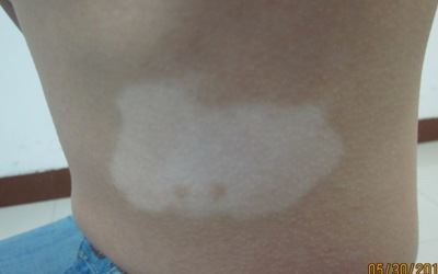 湿润型白癜风是什么症状